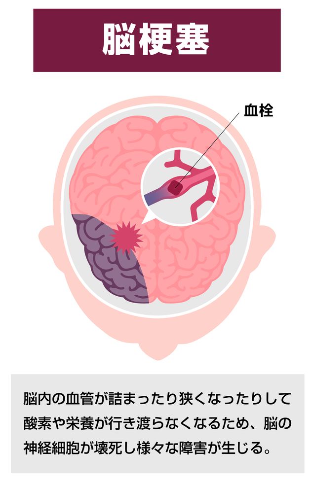 一過性脳虚血発作の懸念点