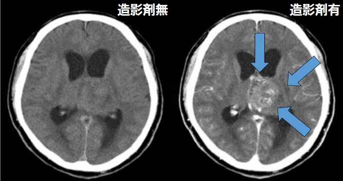 MRI検査でわかること