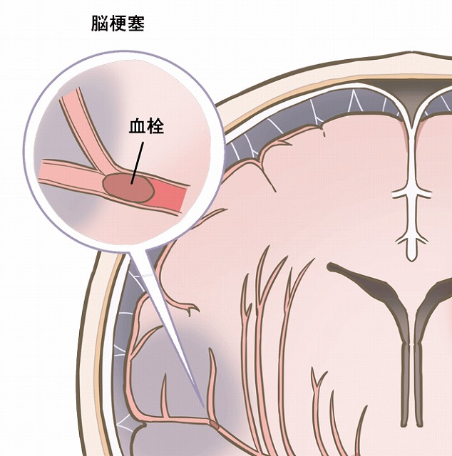 脳梗塞