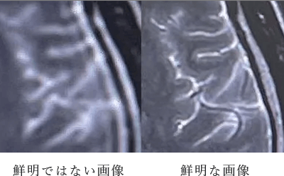 1.5テスラのMRIでより鮮明な検査を実施一般的な脳のMRI検査の1.5～2倍の枚数を撮影