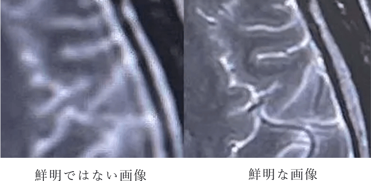 1.5テスラのMRIでより鮮明な検査を実施一般的な脳のMRI検査の1.5～2倍の枚数を撮影