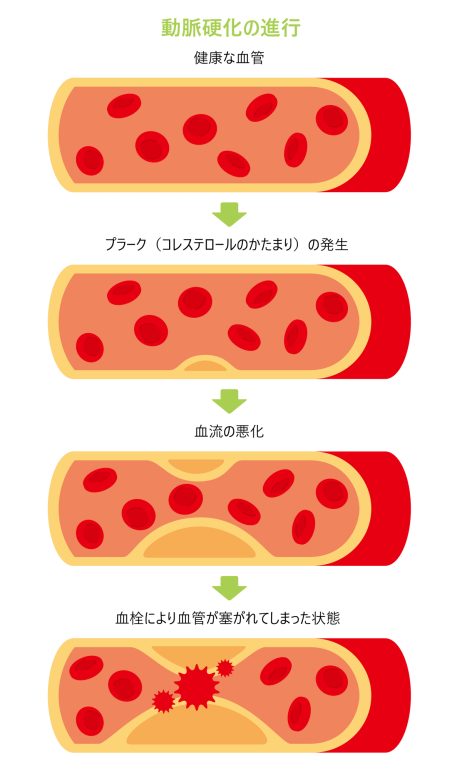 一過性脳虚血発作の原因