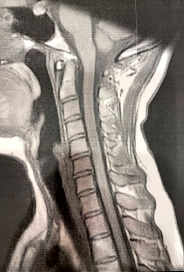 ストレートネックの患者様の画像