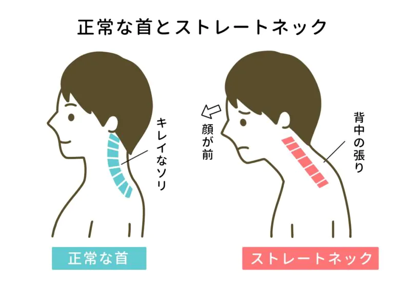 正常な首とストレートネック